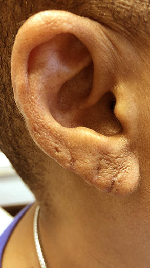 Earlobe Repair, Washington, DC